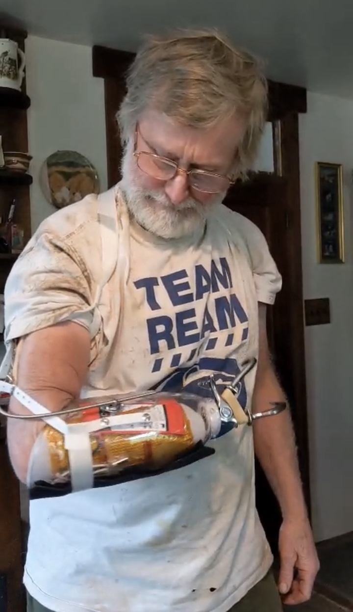 Man with a prosthetic arm